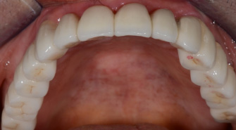 After Dental Implants Treatment