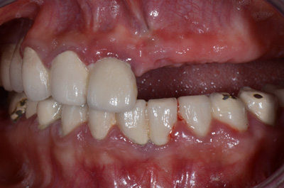 Before Dental Implant Treatment  in India