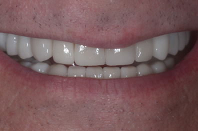 After Smile Designing Treatment in India