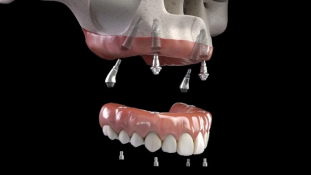 All on 4 treatment protocol