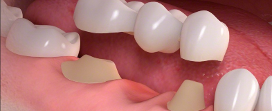 Crowns, Inlays and Onlays for Teeth