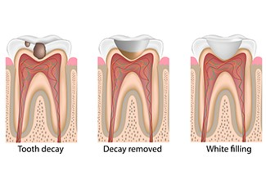 Cavity-Fillings