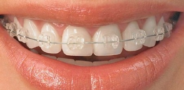 Ceramic Braces