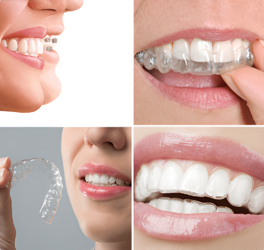 Clear Aligners