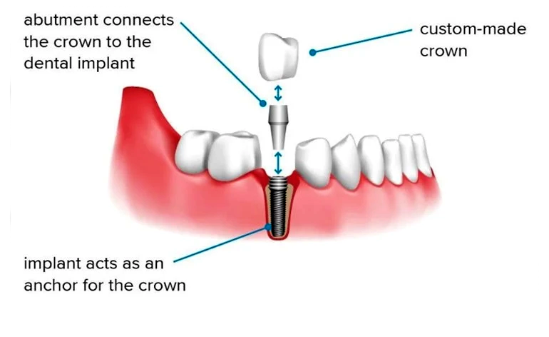 Components-of-Dental-Implants