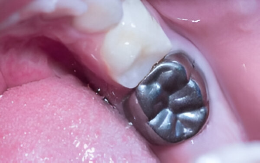 Dental Crowns