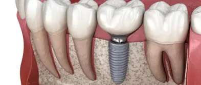 Dental Implants