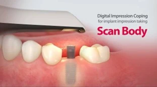 Digital-scanning-to-begin-the-prosthetic-phase-of-the-dental-implant