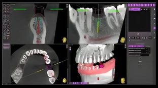 Digitally planning the perfect position of the implant for the surgical guide