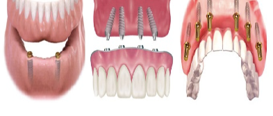 Full Mouth Rehabilitation