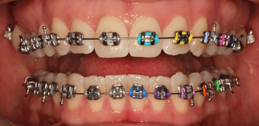 Metal Braces