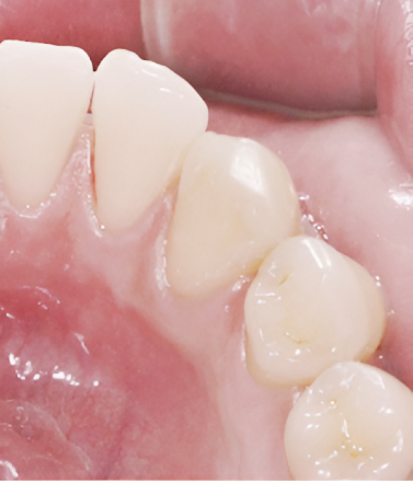 Periodontics Therapy After