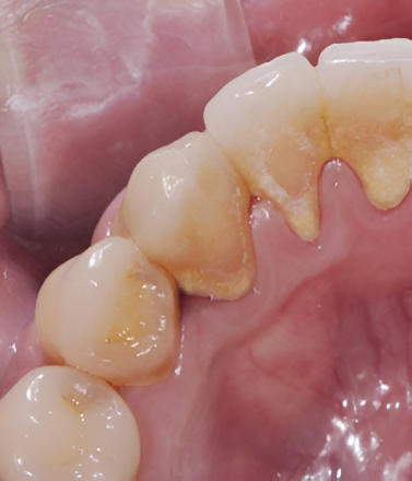 Periodontics Therapy Before