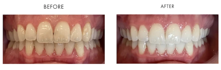 Philips Zoom Whitening Before After Image