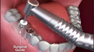 Placing the implants using a 3D printed surgical guide