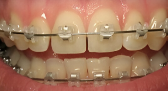 Self-Ligating-Ceramic-Braces