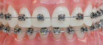 Self-Ligating-Metal-Braces