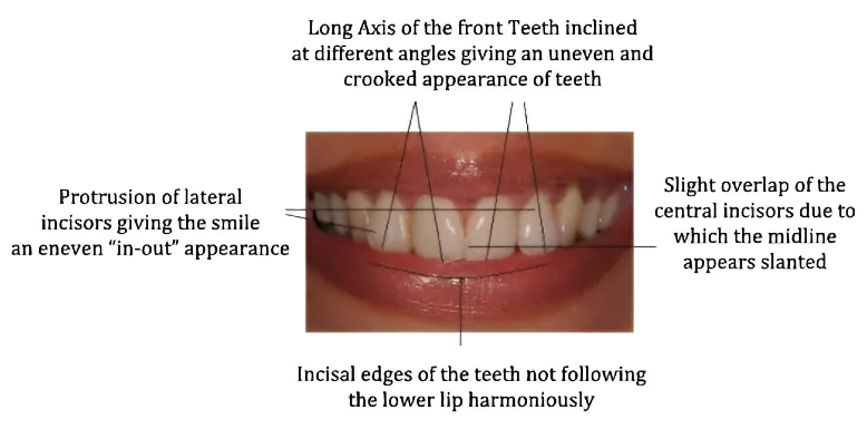 Smile Designing