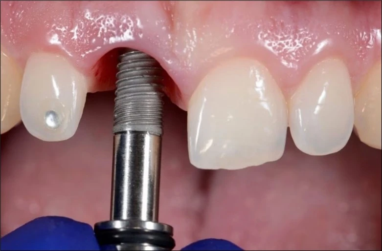 Surgical-Placement-of-a-Dental-Implant