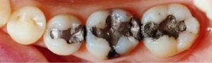 Tooth Colored Fillings Before