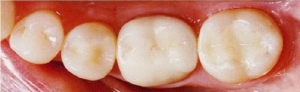 Tooth Colored Fillings After