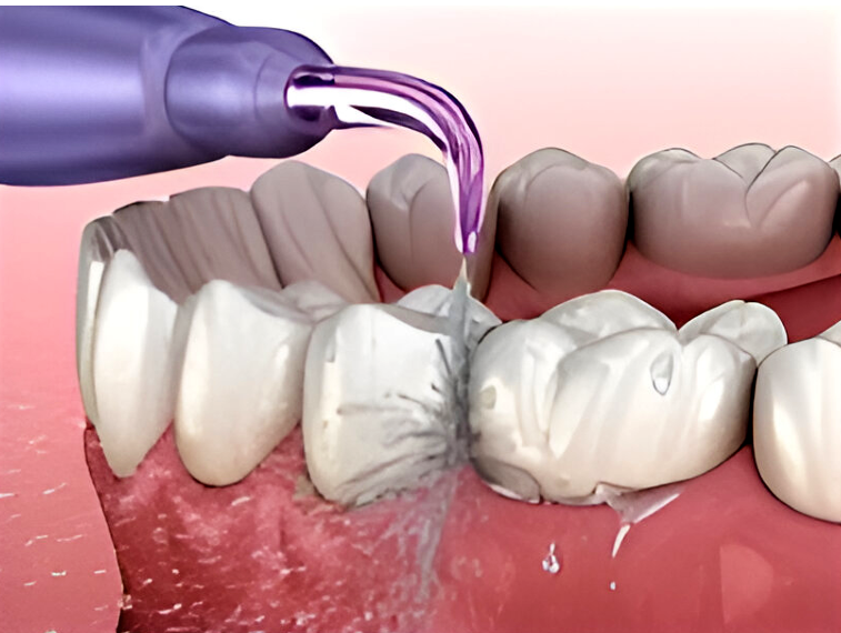 Using a Waterflosser to maintain implant health