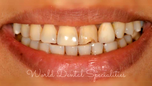 Porcelain Veneers Dentist