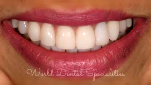 Porcelain Veneers Dentist