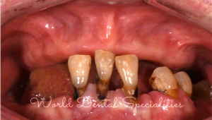 Dental implants