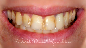 Porcelain Veneers Dentist