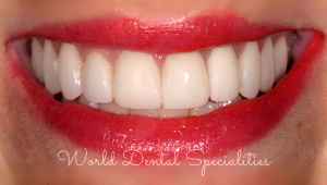 Porcelain Veneers Dentist