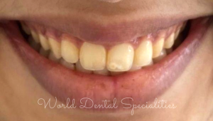 Porcelain Veneers Dentist