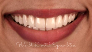 Porcelain Veneers Dentist