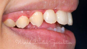 Porcelain Veneers Dentist