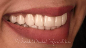 Porcelain Veneers Dentist