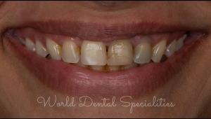 Porcelain Veneers Dentist