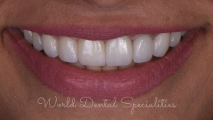 Porcelain Veneers Dentist