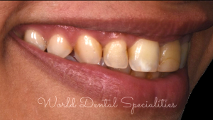 Porcelain Veneers Dentist