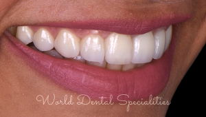 Porcelain Veneers Dentist