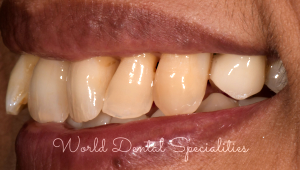 Porcelain Veneers Dentist