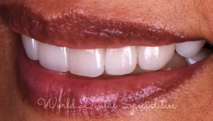 Porcelain Veneers Dentist