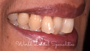 Porcelain Veneers Dentist