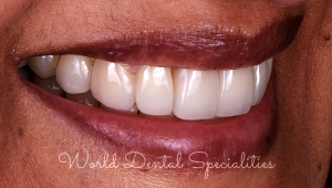 Porcelain Veneers Dentist