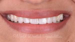 Porcelain Veneers Dentist