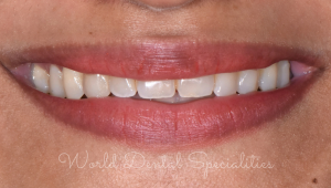 Porcelain Veneers Dentist