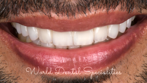 Porcelain Veneers Dentist