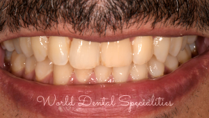 Porcelain Veneers Dentist