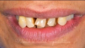 Dental implants