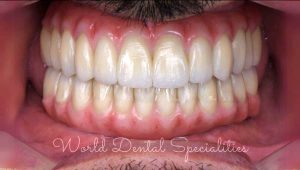 Dental implants