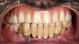 Dental implants